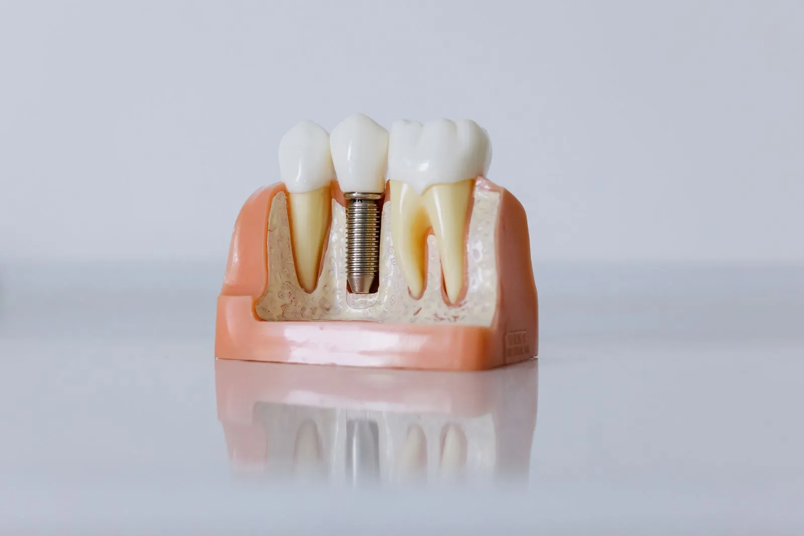 Modelo en corte que muestra un implante de titanio en el hueso, entre dos dientes naturales