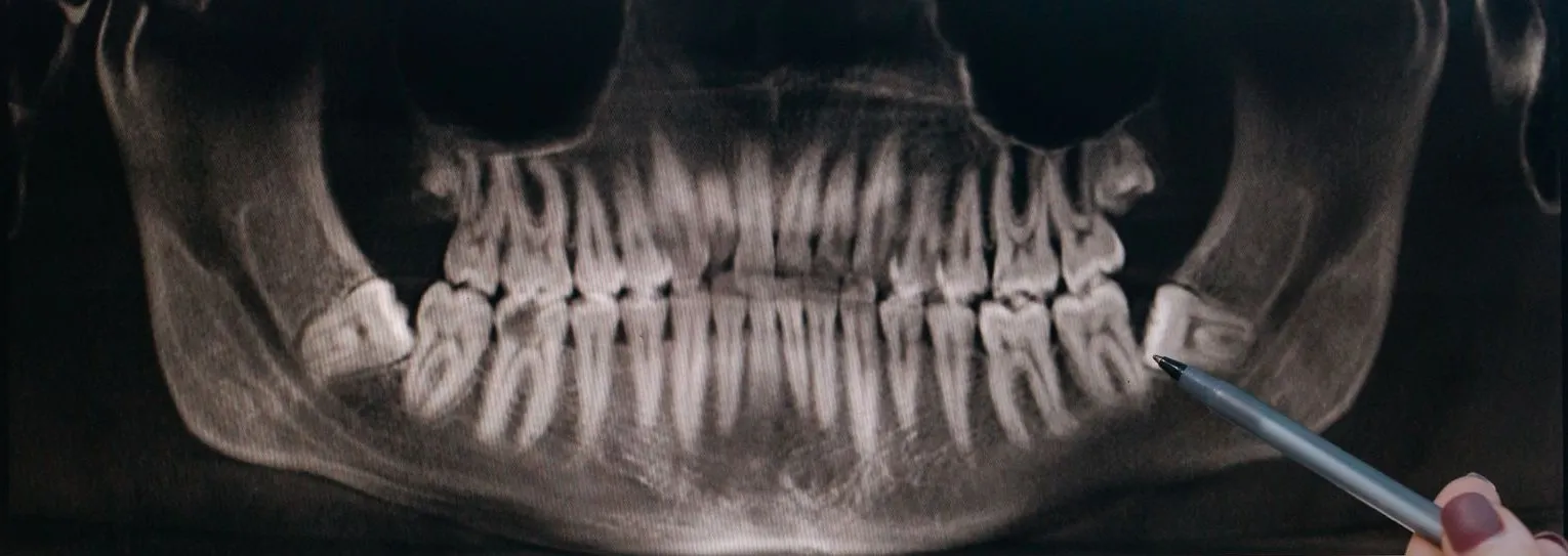 Radiografía panorámica en pantalla con un bolígrafo señalando una muela del juicio